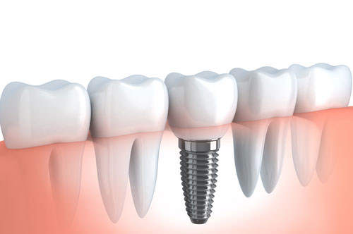 Why Try Dental Implants?