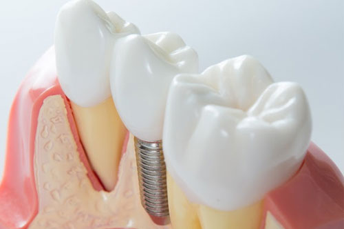 A Dental Implants Success Story In Warrenton VA