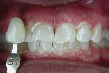 Smile Gallery - After Teeth Whitening Sample 3