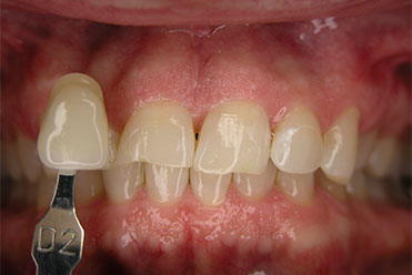 Smile Gallery - Before Teeth Whitening Sample 3