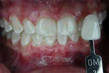 Smile Gallery - After Teeth Whitening Sample 4