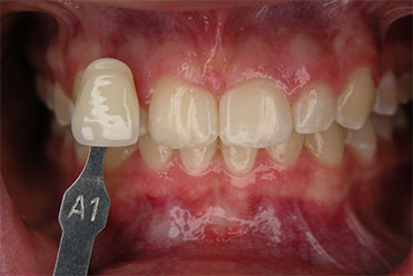 Smile Gallery - Before Teeth Whitening Sample 4