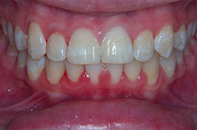 Q-after-orthodontics